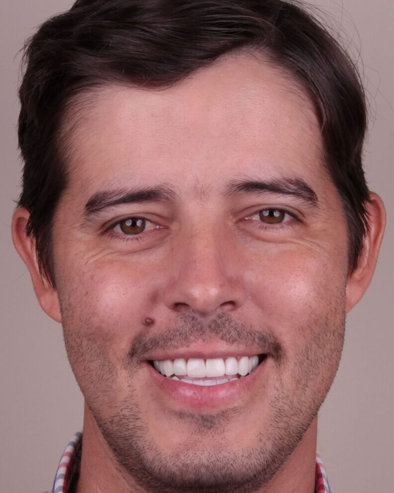 Depois — Sorriso mais claro e proporcional