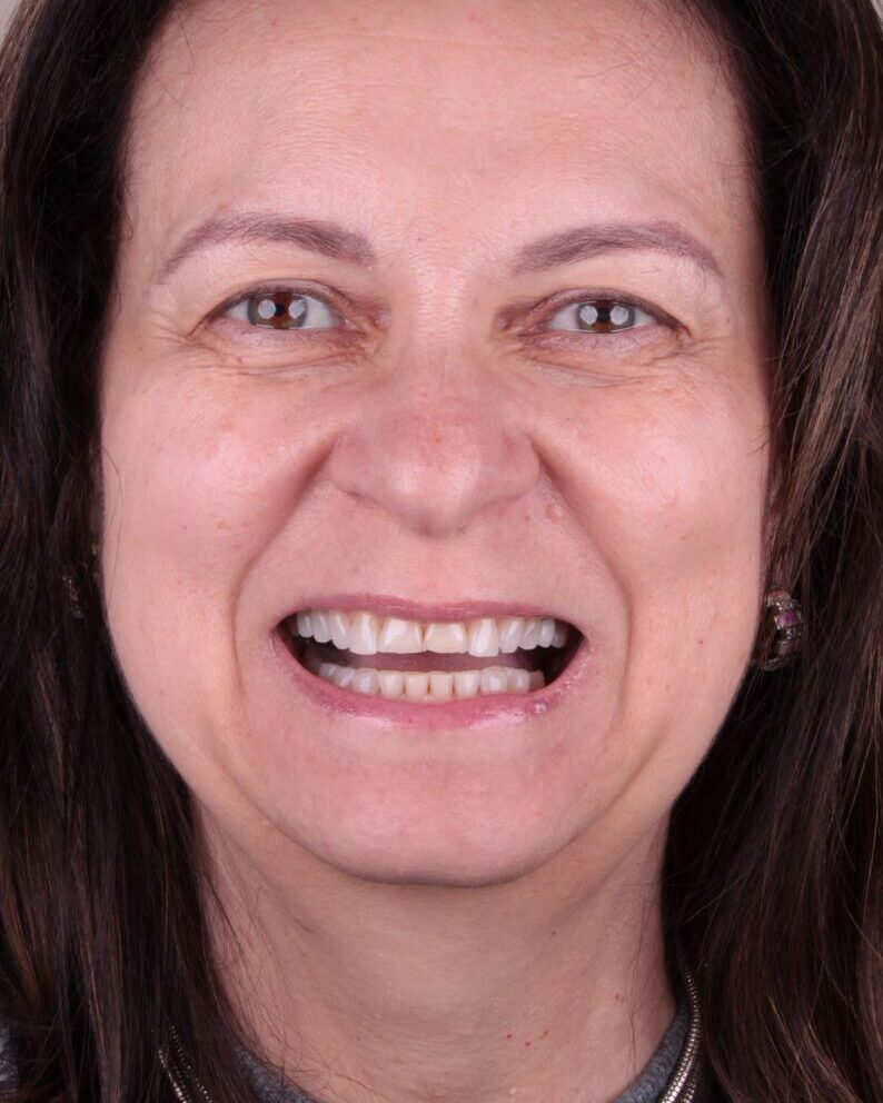Antes — Renovação completa do sorriso