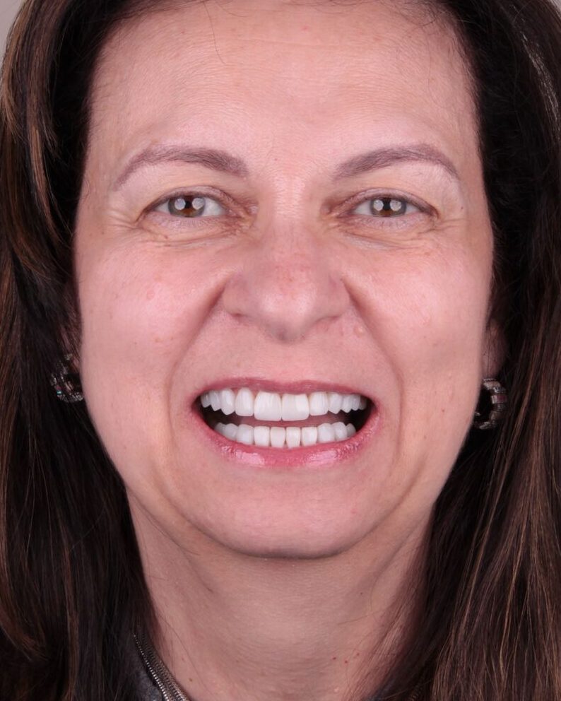 Depois — Renovação completa do sorriso