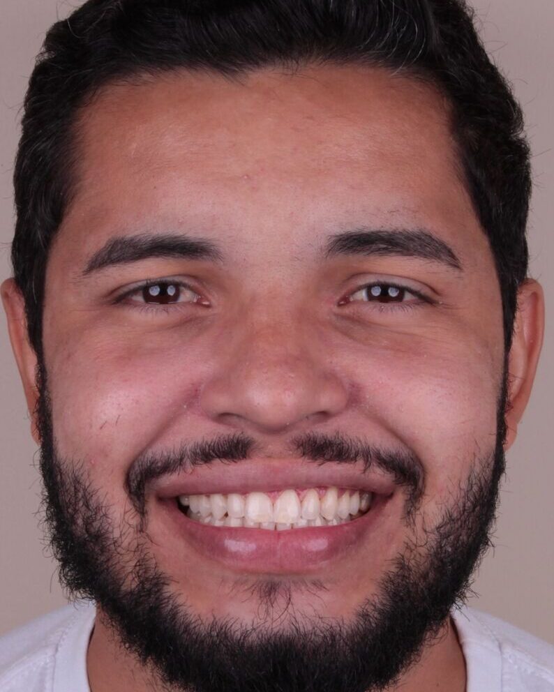 Antes — Reanatomização e alinhamento do sorriso