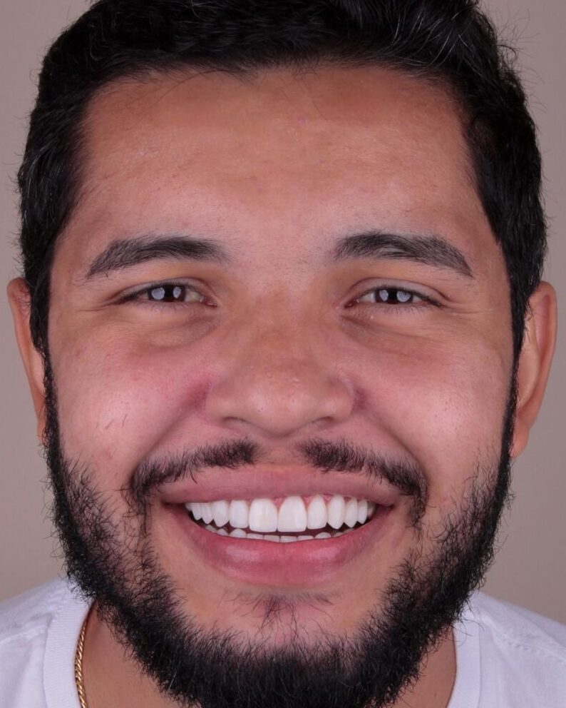 Depois — Reanatomização e alinhamento do sorriso