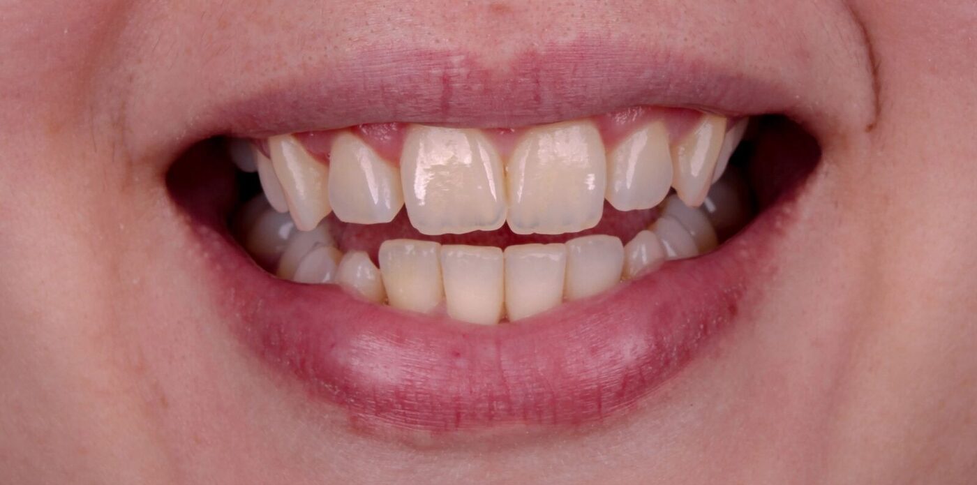 Antes — Desenho do sorriso com naturalidade