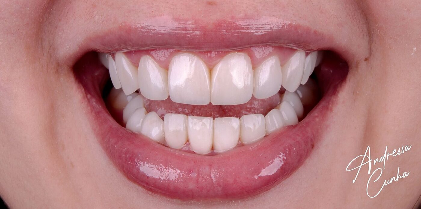 Depois — Desenho do sorriso com naturalidade