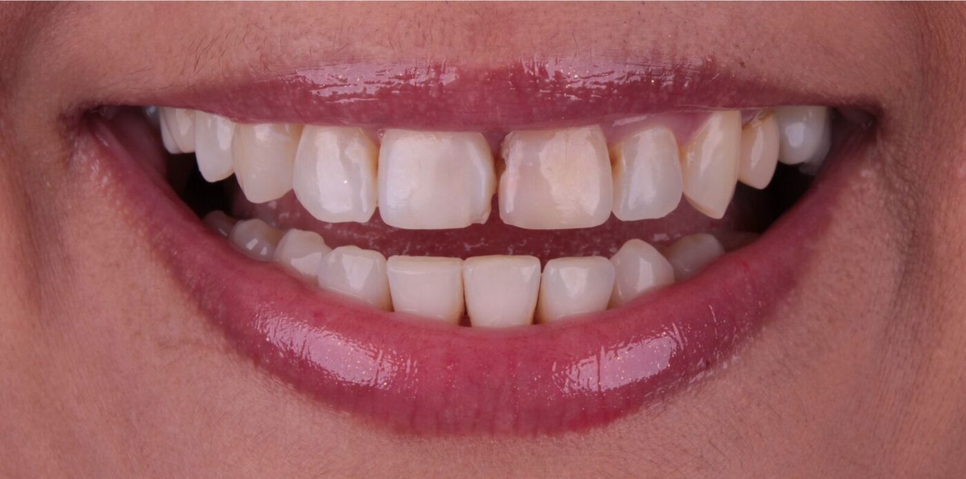 Antes — Correção de forma e fechamento de diastema