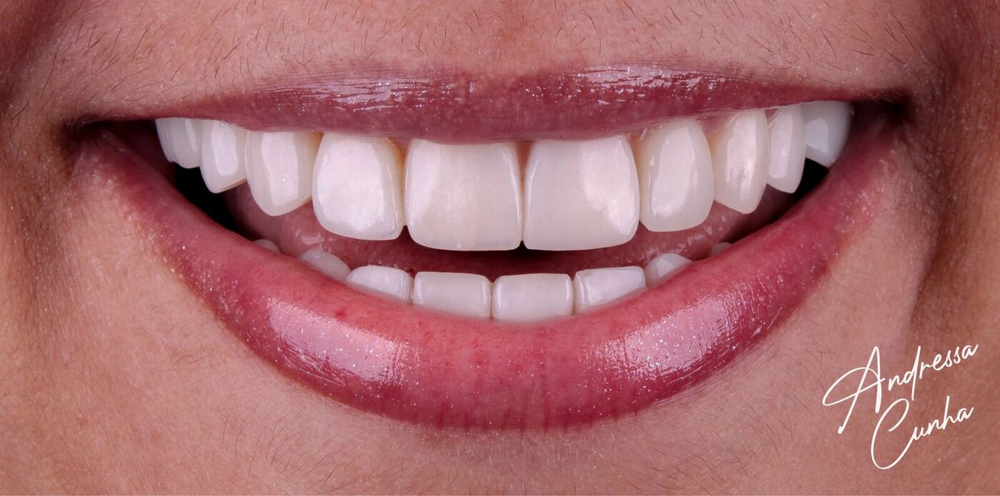 Depois — Correção de forma e fechamento de diastema