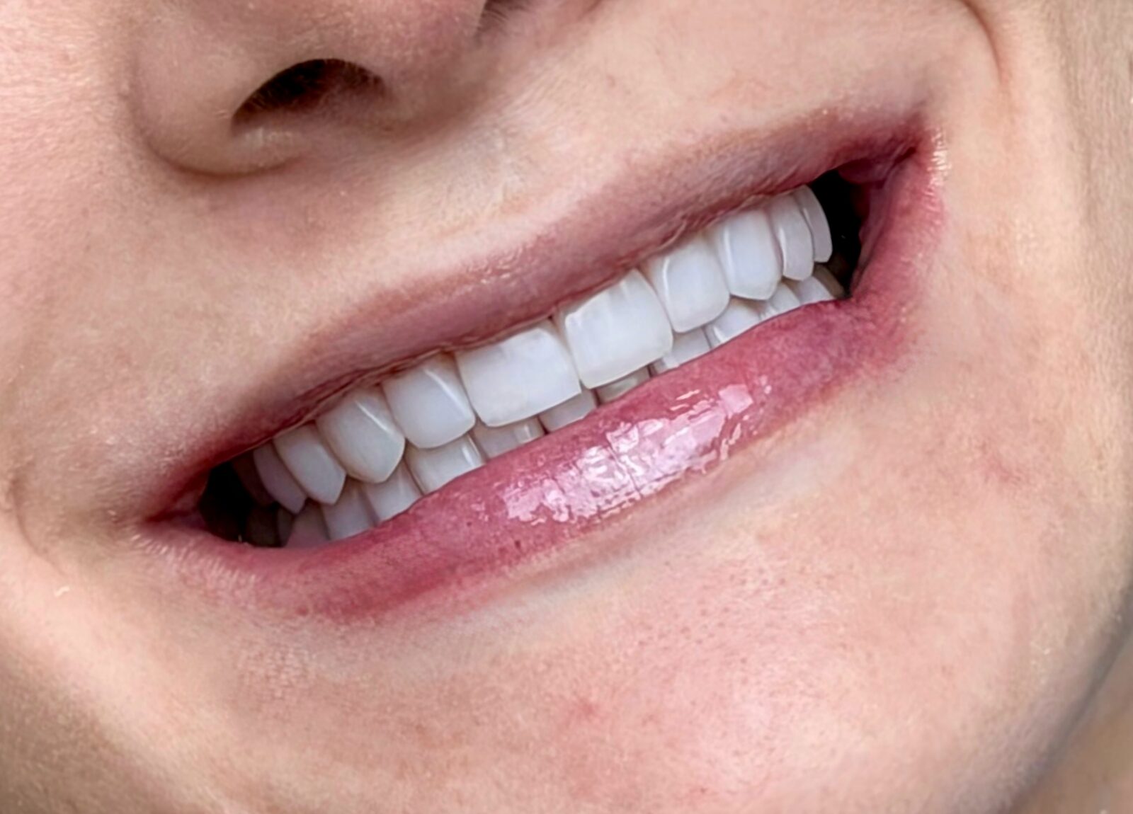 Close de um sorriso finalizado com lentes de resina